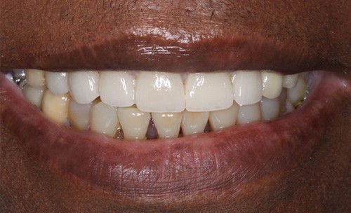 c3-short-teeth-after