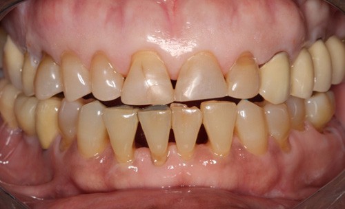 c3-short-teeth-before