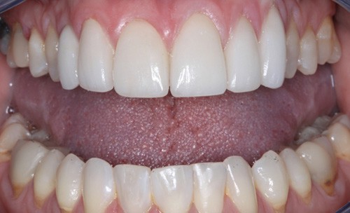c5-spaces-teeth-after