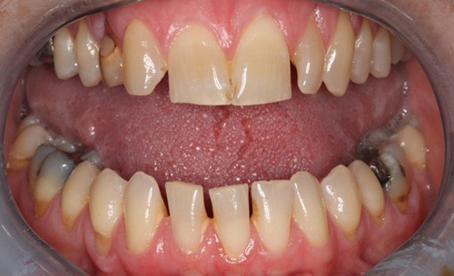 c5-spaces-teeth-before